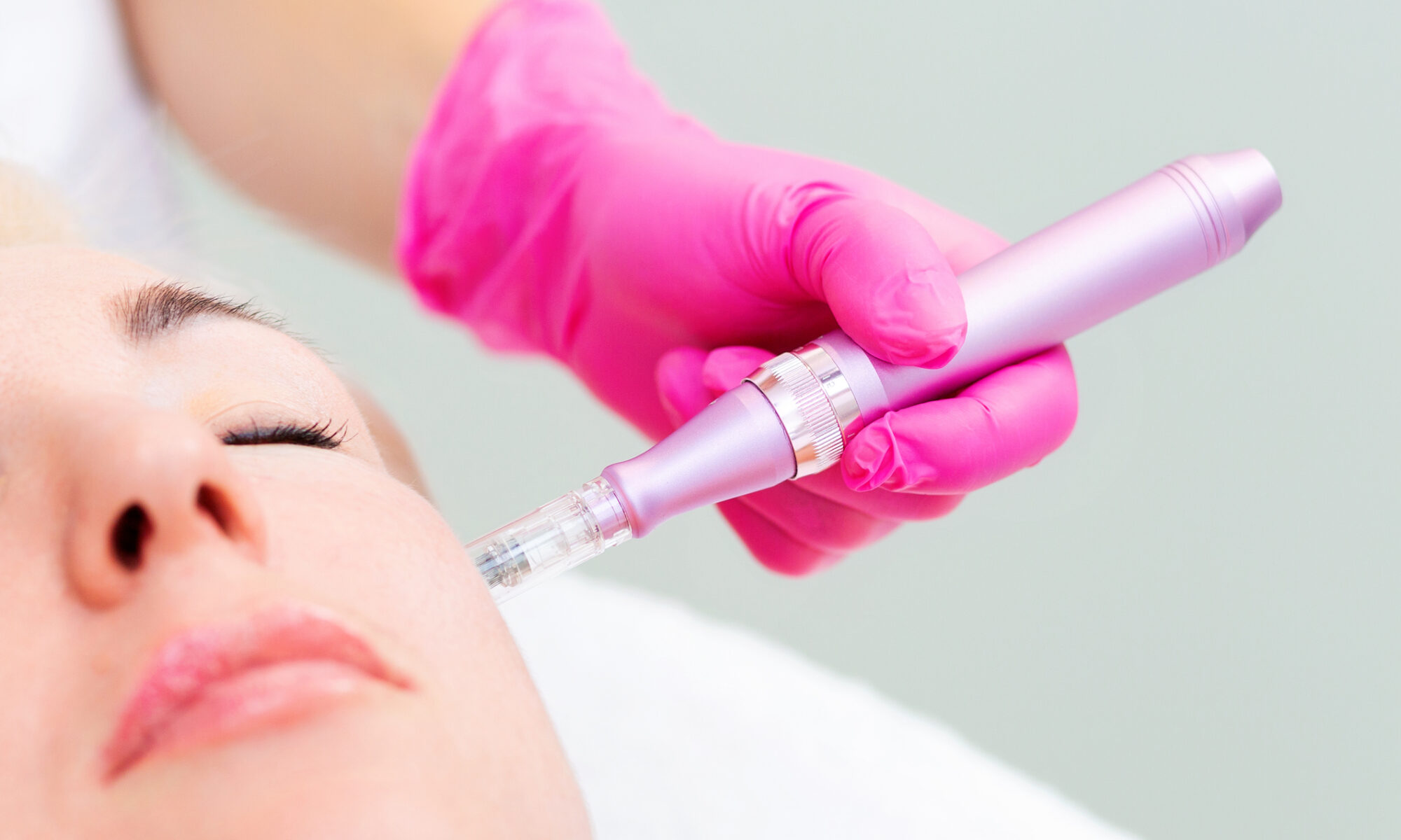 Microneedling bei Narben