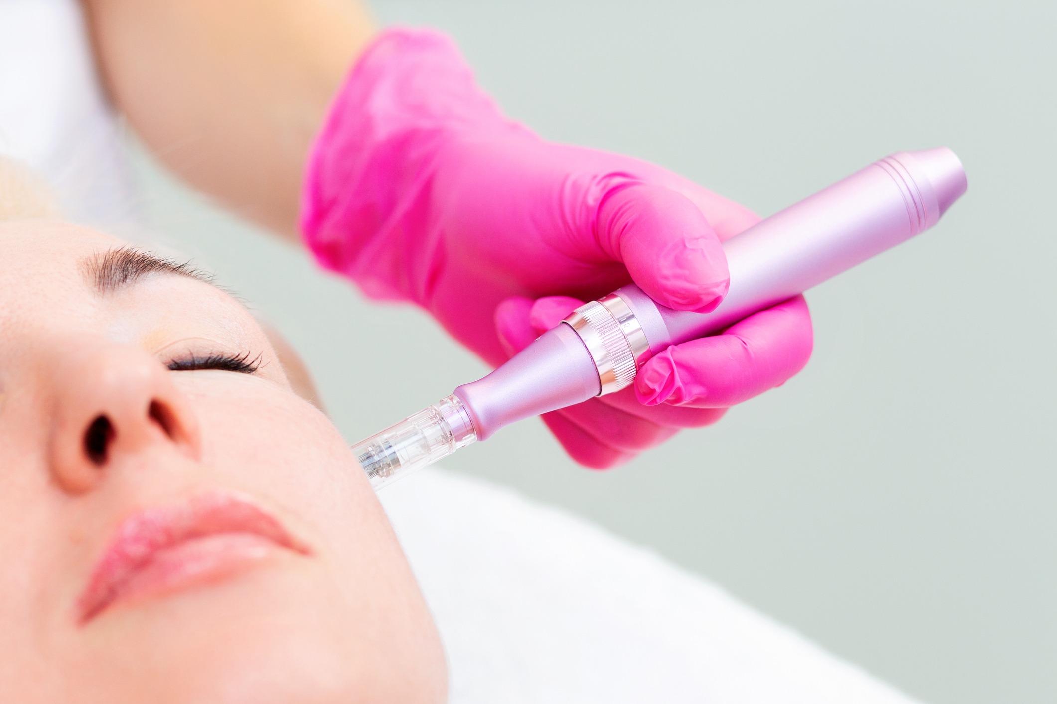 Microneedling bei Narben Microneedling bei Narben